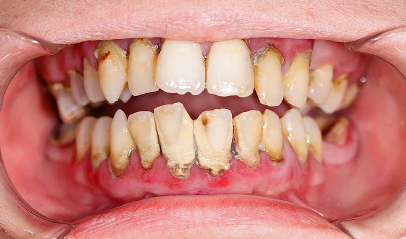8 tác hại của việc không đánh răng bạn không nên chủ quan | Vinhan