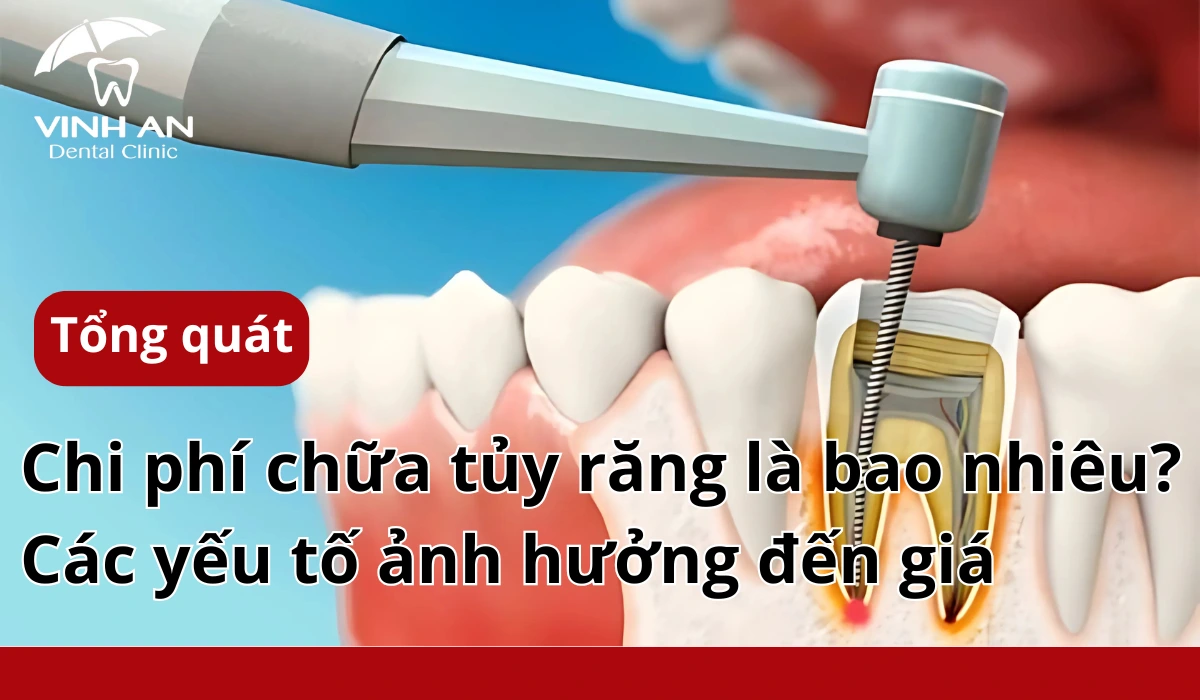 Chi-phi-lay-tuy-rang
