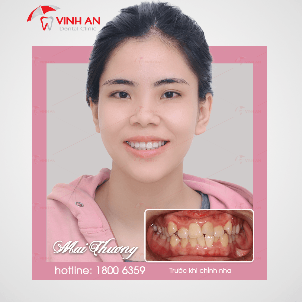 Bệnh nhân sau khi chỉnh nha tại Vinh An