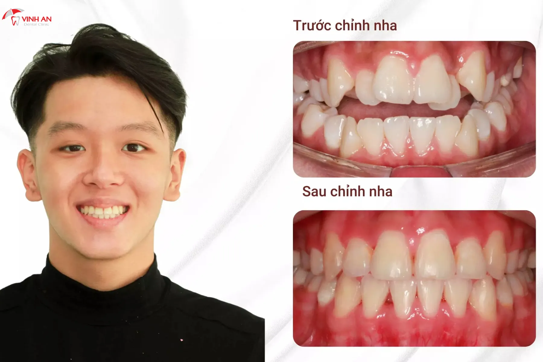 Nieng-rang-trong-suot (1)