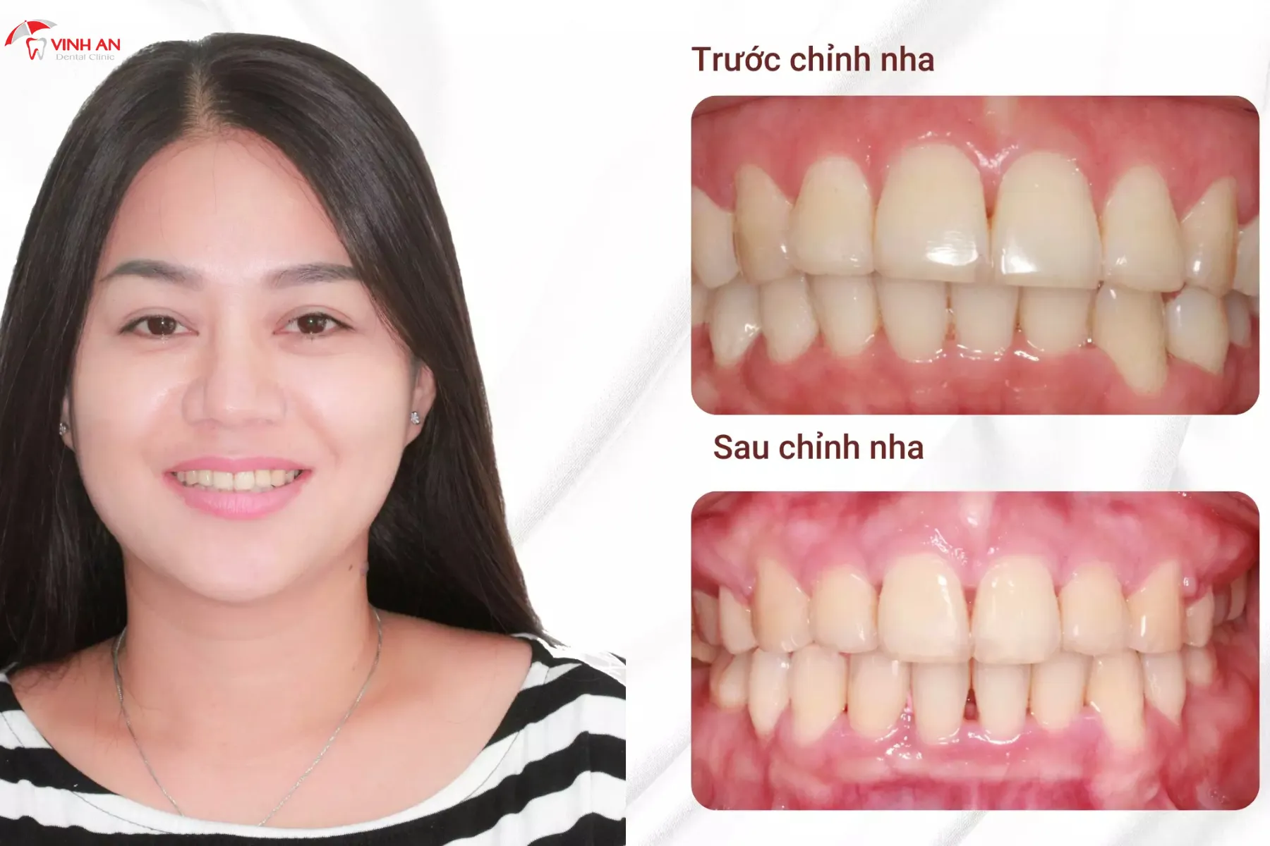 Nieng-rang-trong-suot (2)