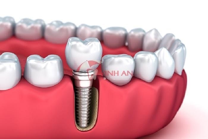 ky-thuat-cay-ghep-implant-co-khac-gi-so-voi-ky-thuat-khac