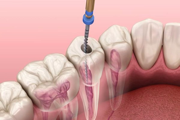 Nguyên Nhân, Triệu Chứng Và Cách Điều Trị Viêm Tủy Răng