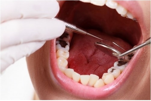 Phương pháp trám răng sâu lỗ to mang đến những lợi ích gì