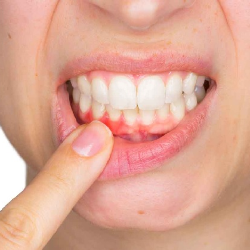 Nhiễm khuẩn răng miệng là gì?