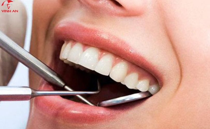 cạo vôi răng và tẩy trắng răng bao nhiêu tiền