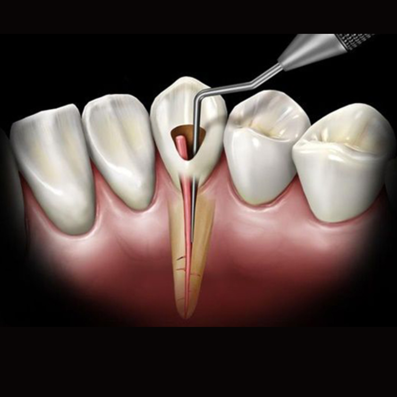 Những trường hợp nào cần điều trị tủy răng?