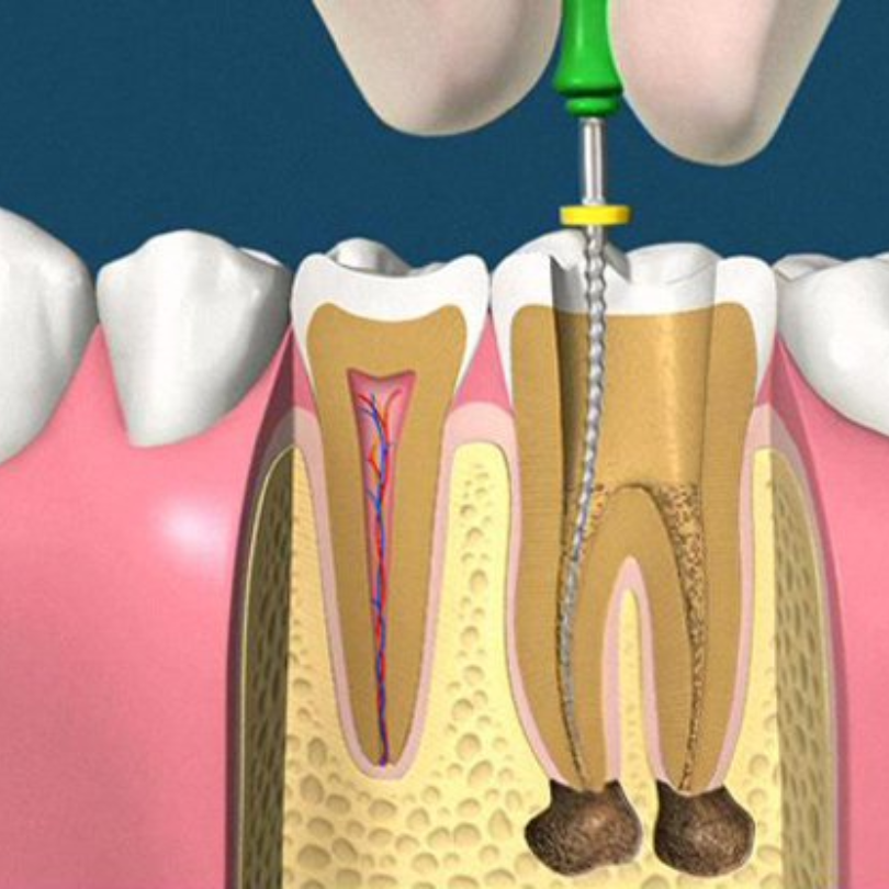 Các tips chăm sóc răng miệng sau khi lấy tủy