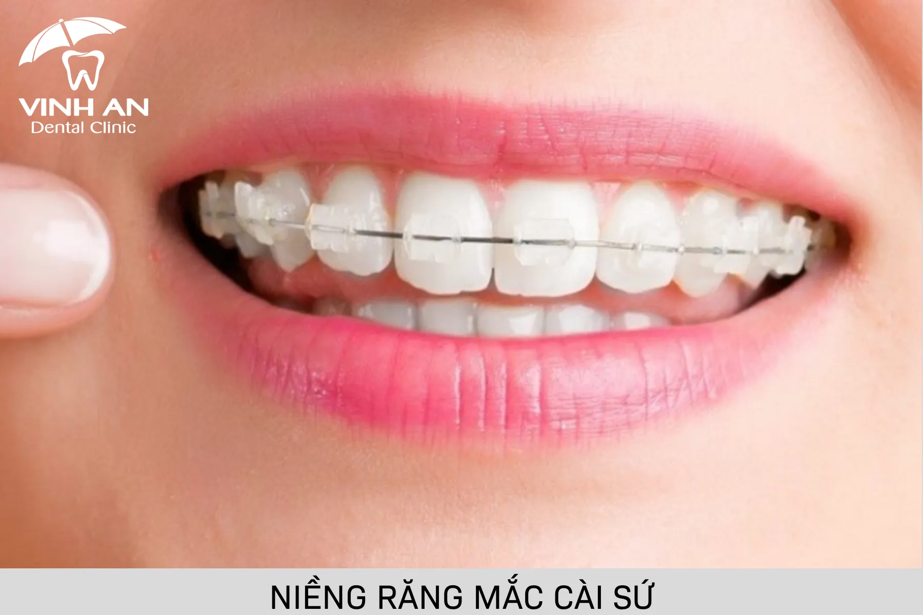 Chi Phí Niềng Răng