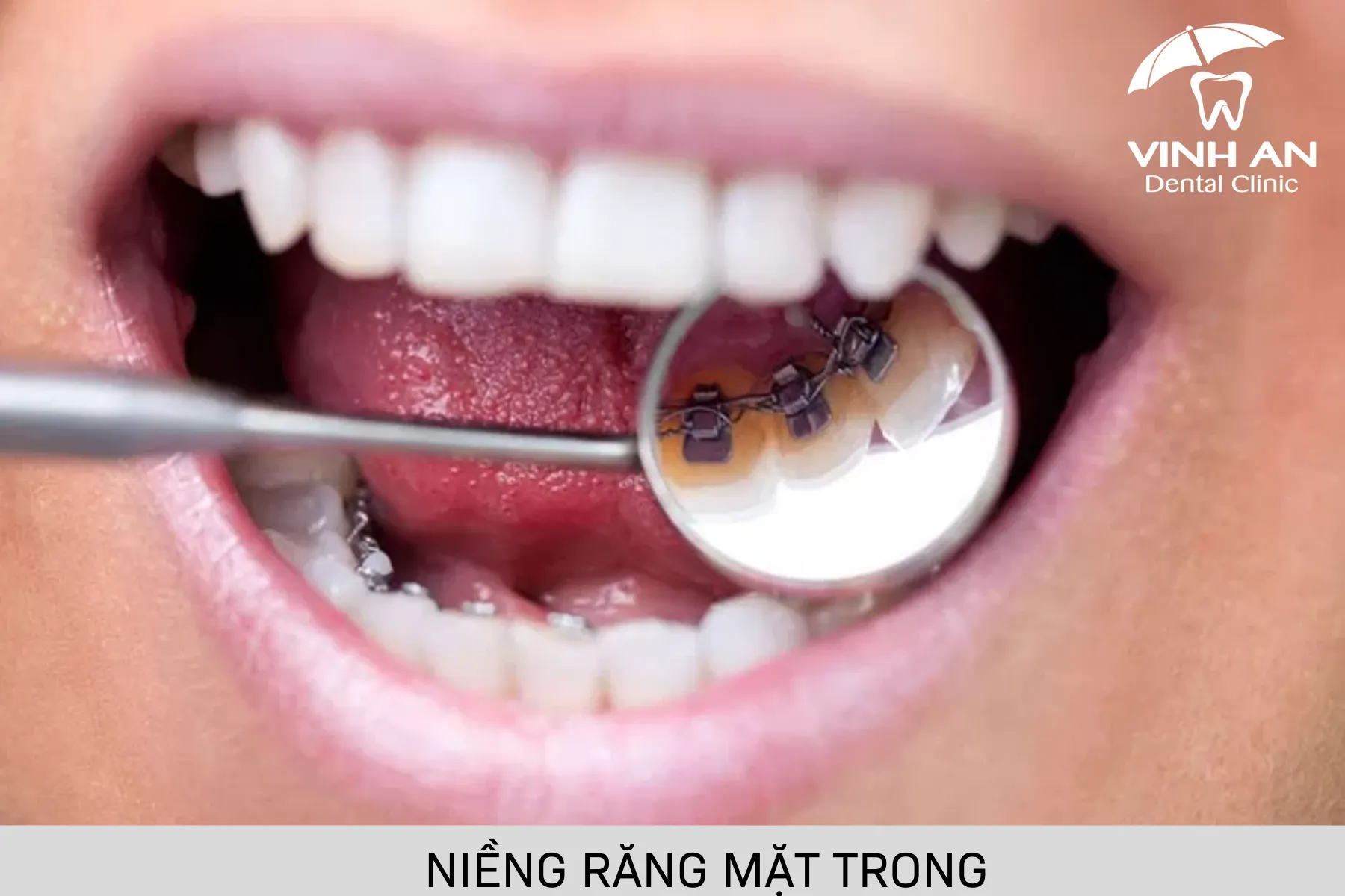 Chi Phí Niềng Răng