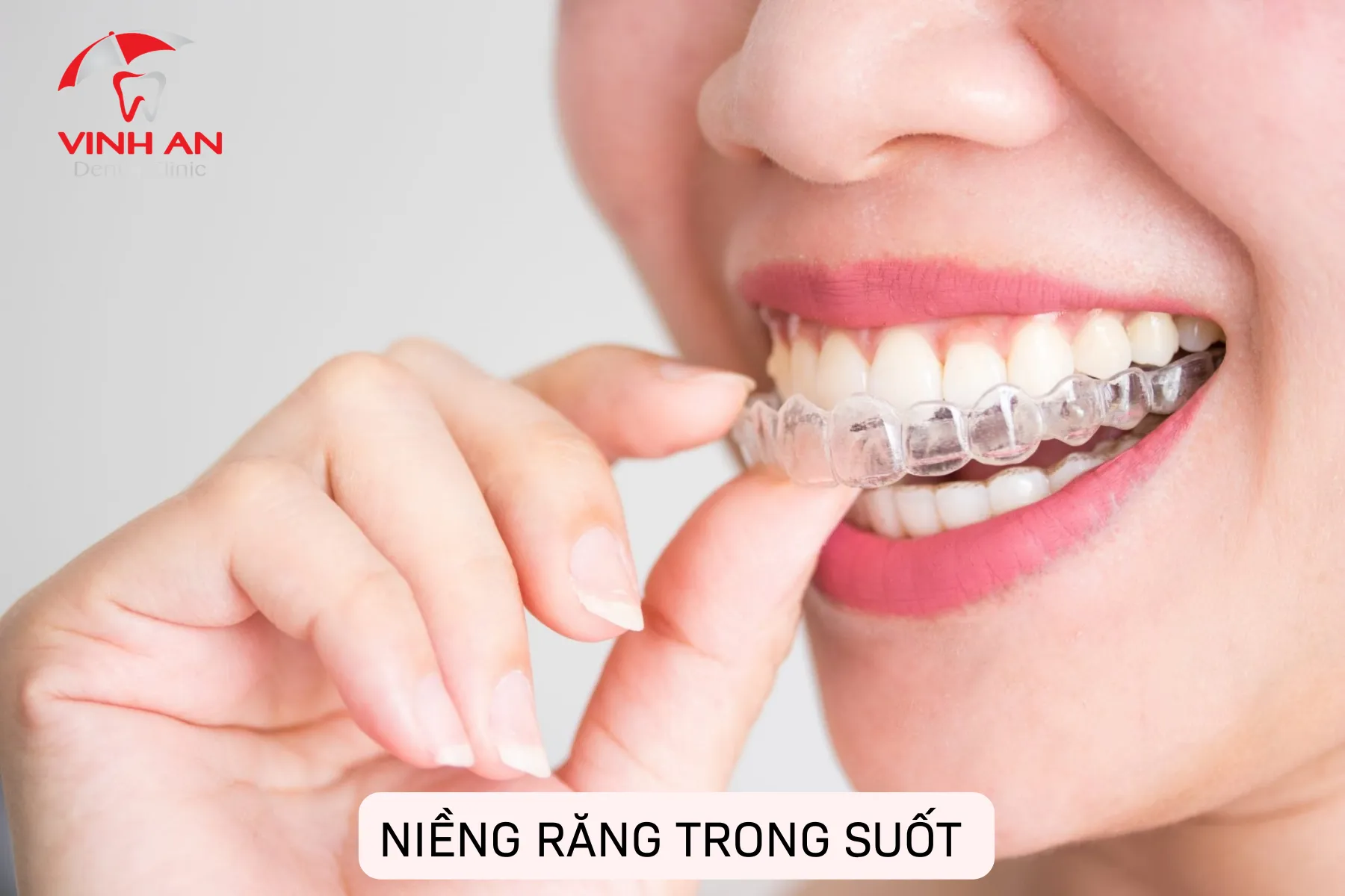 Chi Phí Niềng Răng