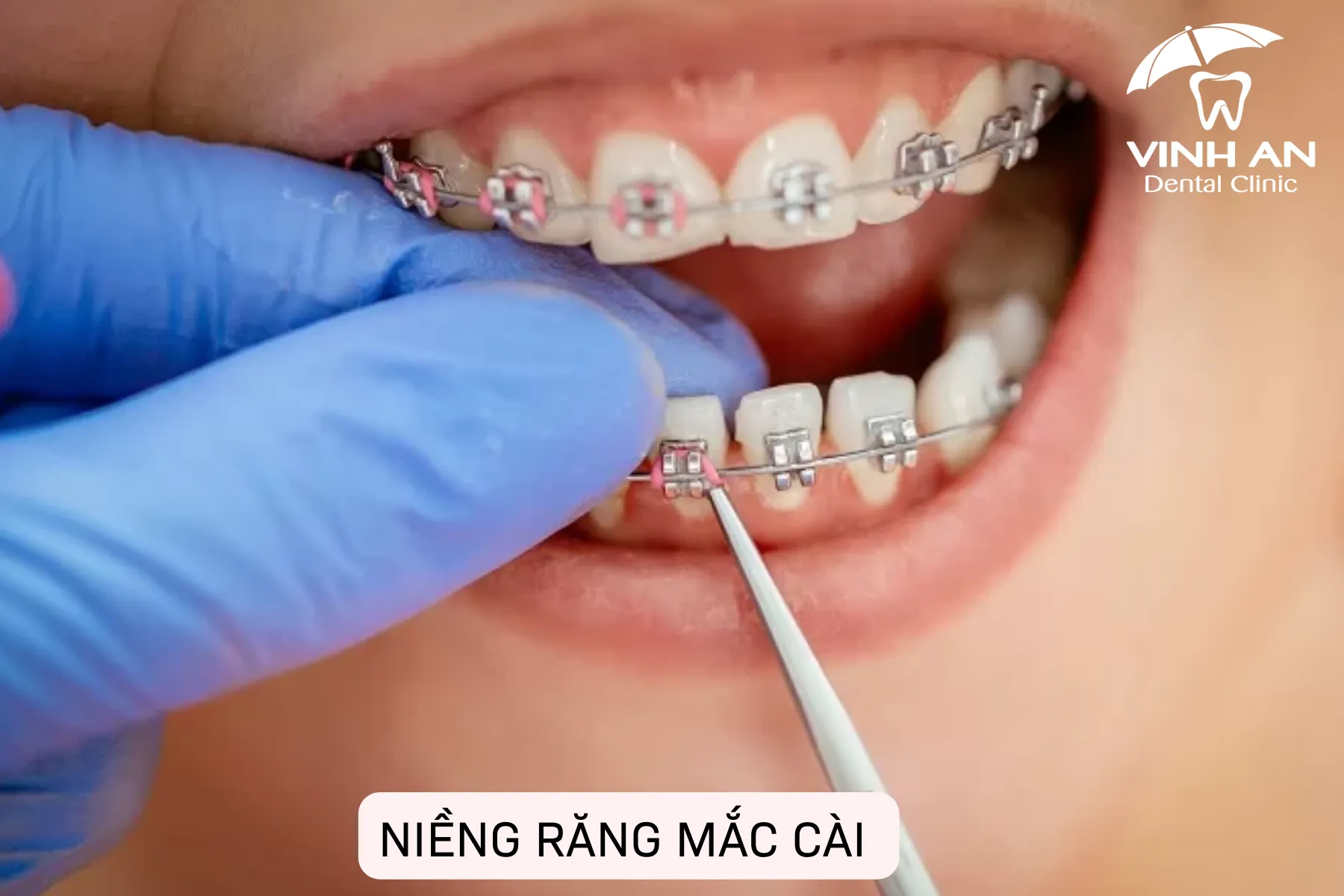 Chi Phí Niềng Răng