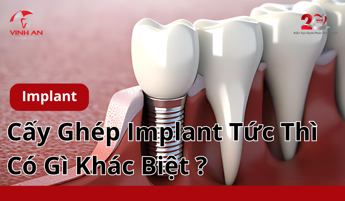 Cấy ghép Implant tức thì có gì khác biệt?