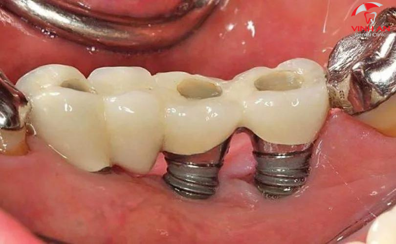 Những biến chứng có thể gặp sau trồng răng