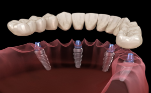 Trồng răng implant toàn hàm là gì