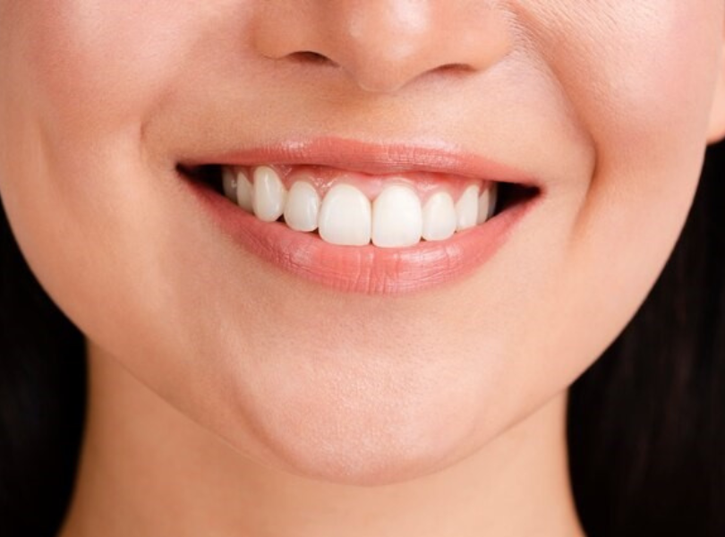 Mẫu Răng Sứ đẹp 4