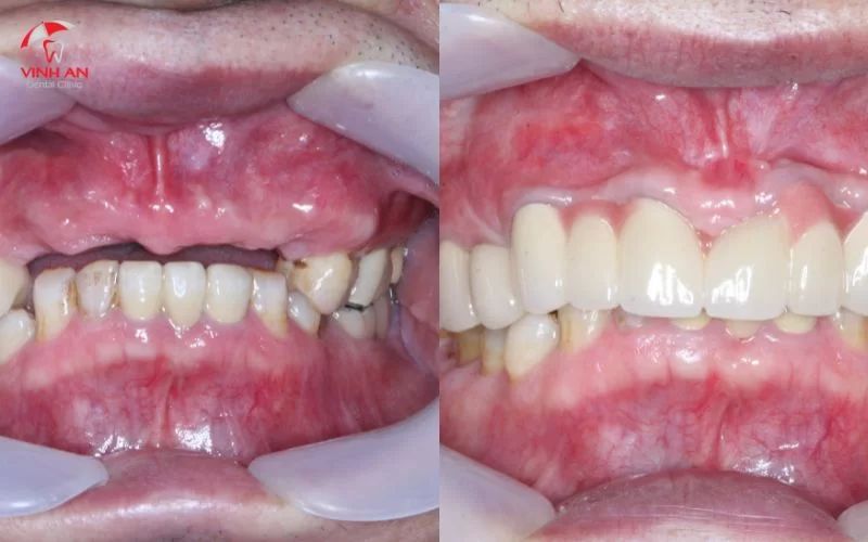 Hình ảnh khách hàng trước và sau khi trồng răng Implant tại trung tâm Implant chuyên sâu Vinh An