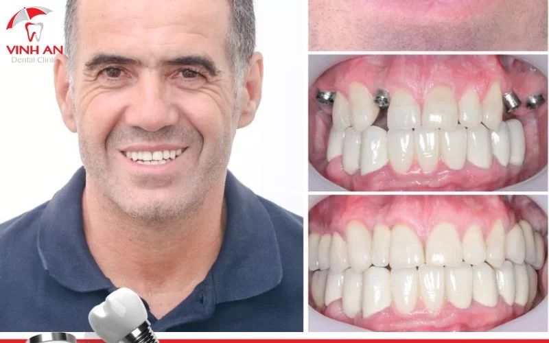 Hình ảnh khách hàng trước và sau khi trồng răng Implant tại trung tâm Implant chuyên sâu Vinh An