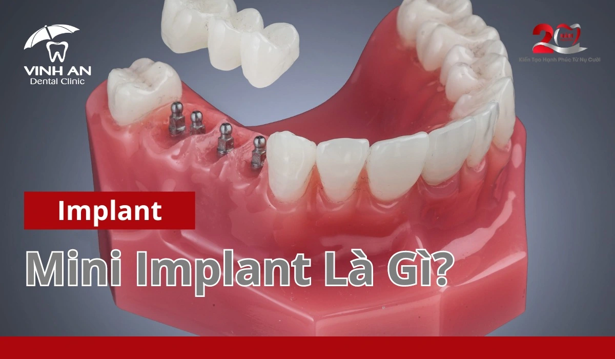 Mini-implant
