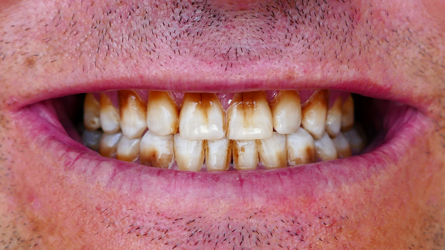 Răng đậm Màu (2)