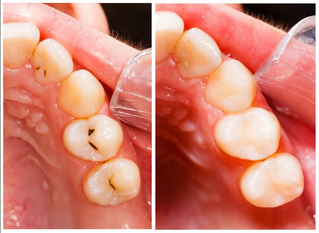 bọc răng sứ được bao nhiêu năm