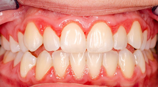 Bị viêm lợi sau khi bọc răng sứ