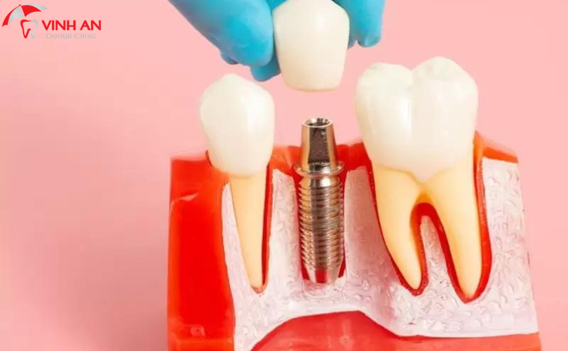 Trụ Implant Dentium Hàn Quốc Có Tốt Không?