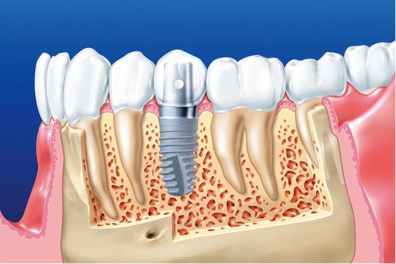 Phẫu Thuật Ghép Xương Răng Trong Implant