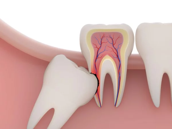 Răng Cấm Là Răng Nào? Nhổ Răng Cấm Có Nguy Hiểm Không?