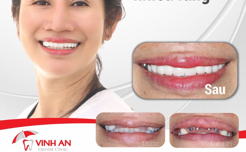 Trồng Răng Implant Có Nguy Hiểm Không? Những Biến Chứng Bạn Có Thể Gặp
