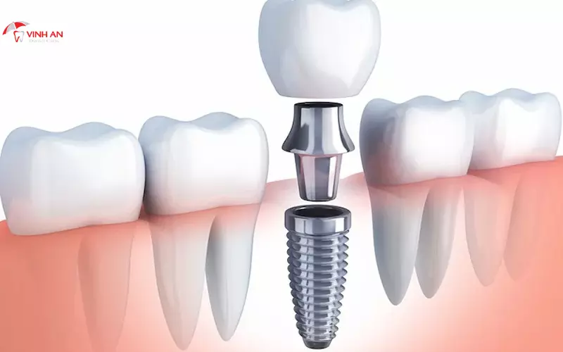 Trồng răng Implant bị đào thải