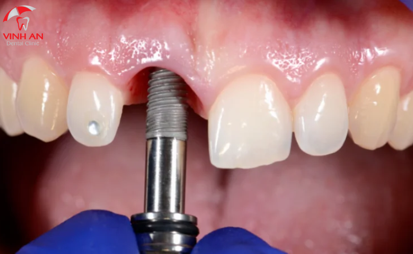 Trồng Răng Implant Có Niềng Răng Được Không