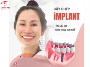 Sau khi trồng răng Implant nên ăn gì và kiêng gì?