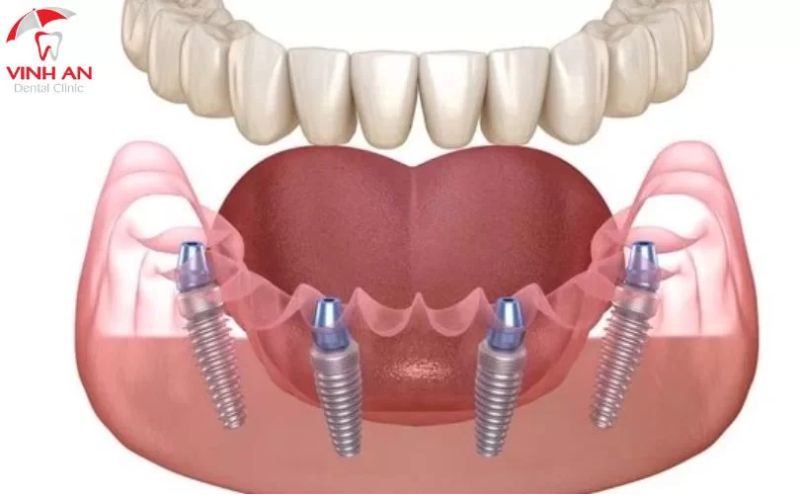 Độ Bền Của Implant Phụ Thuộc Vào Nhiều Yếu Tố