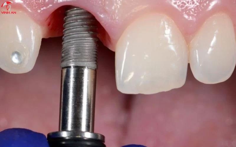 Giá Trồng Răng Implant