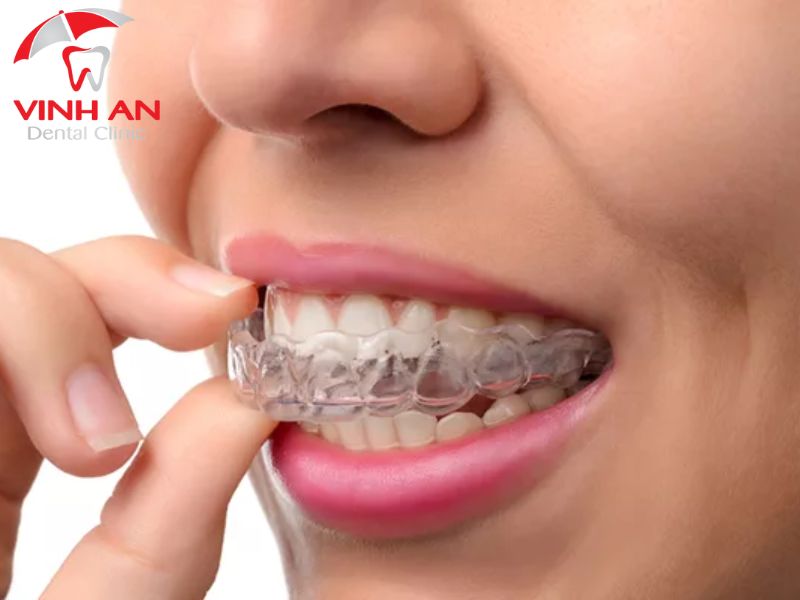 Niềng Răng Tháo Lắp
