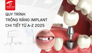 Quy trình trồng răng Implant từ a-z