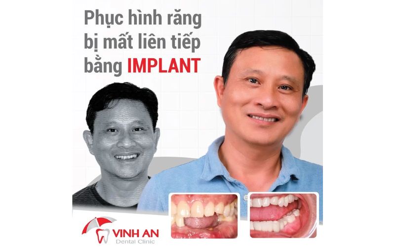 Review Từ Nam Khách Hàng đã Trồng Răng Implant