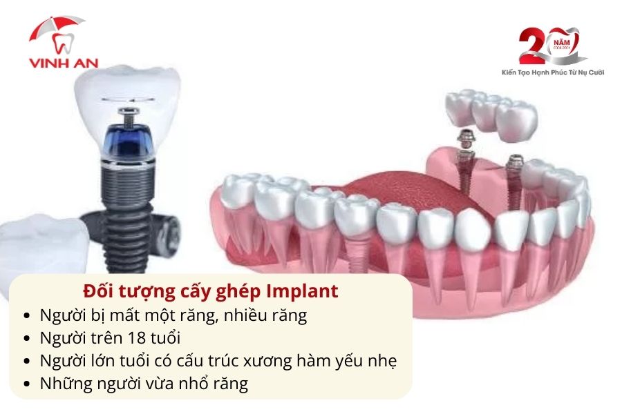 Trồng Răng Bằng Cấy Ghép Implant Có Thật Sự Tốt 3