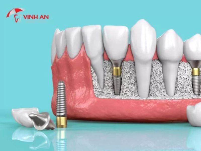 Trồng Răng Implant Tại Tp.hcm