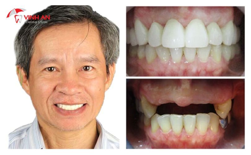 Trồng Răng Implant Tại Tphcm