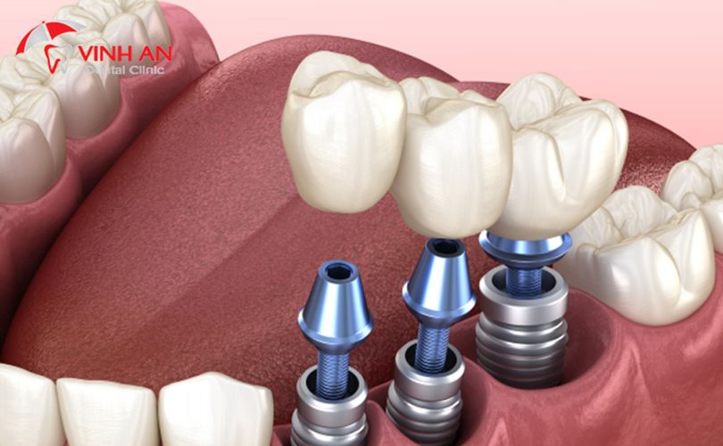 Trồng Răng Implant Tại Tphcm 