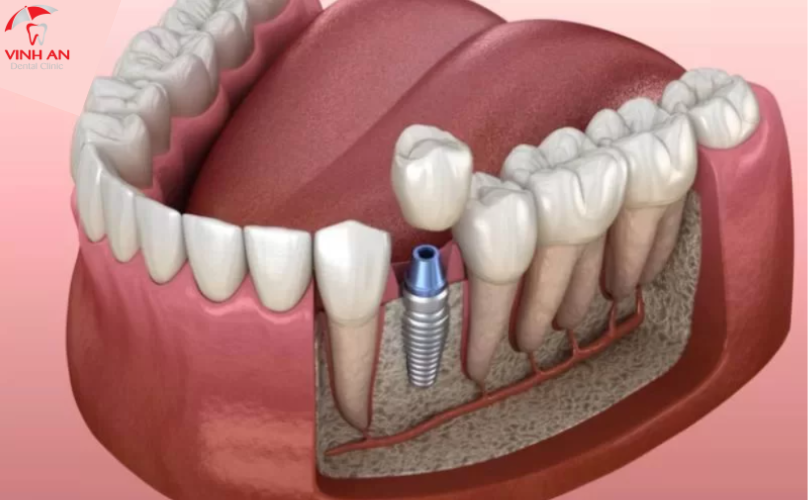 Trồng Răng Implant Trả Góp