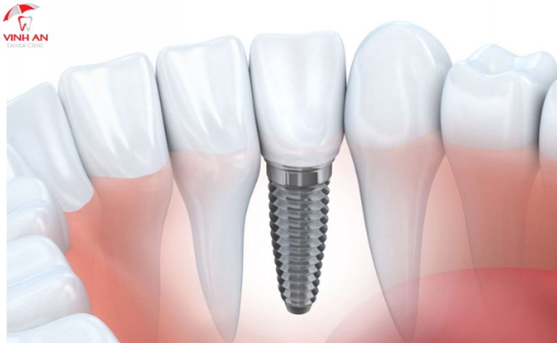 Trồng Răng Implant Trả Góp
