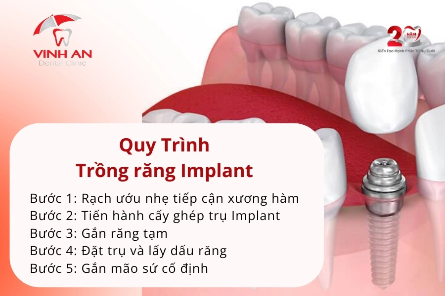 Trồng Răng Implant Có đau Không