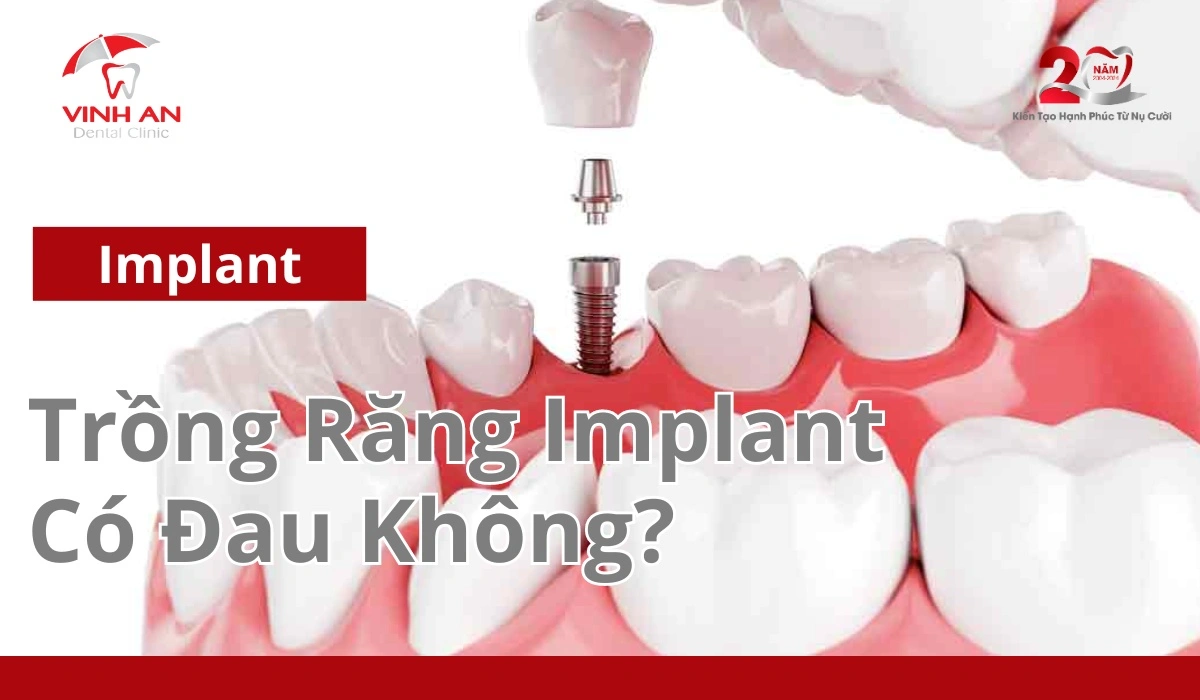 Trồng Răng Implant Có đau Không