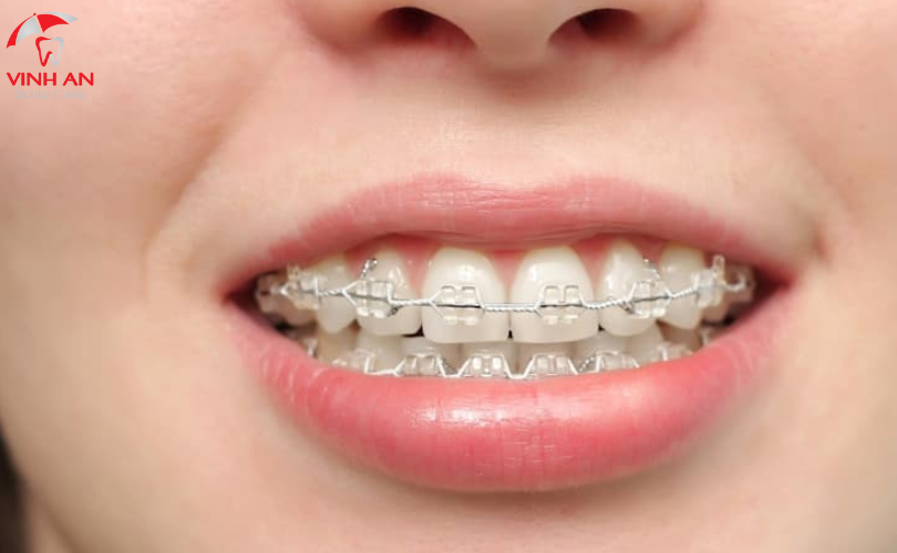 Trồng Răng Implant Có Niềng Răng được Không