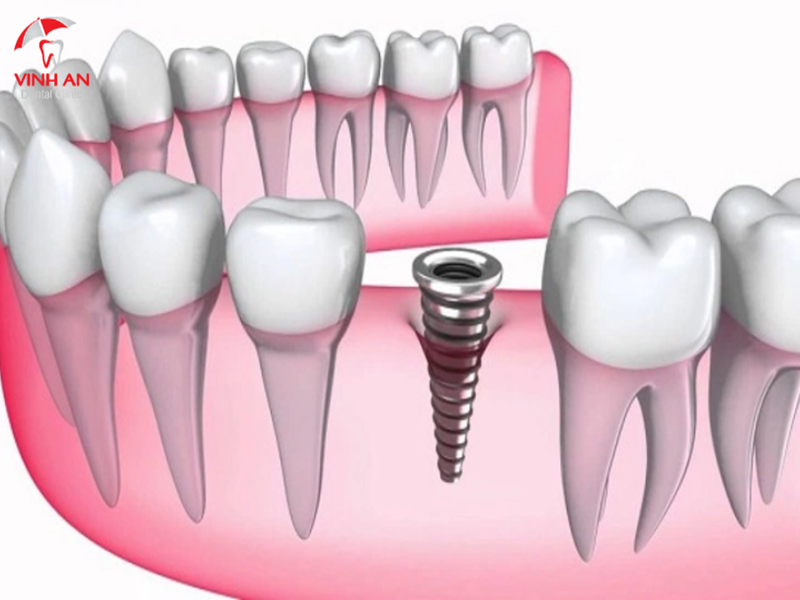 Trồng Răng Implant Mất Bao Lâu Thì Xong