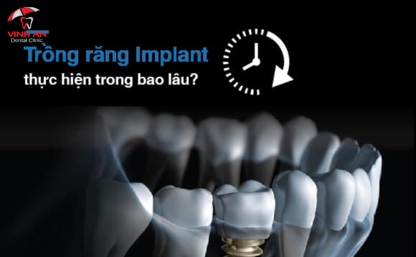 Trồng Răng Implant Mất Bao Lâu Thì Xong