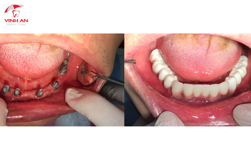 Cần Lưu Ý Những Gì Sau Khi Trồng Răng Implant?